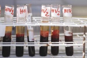 Aids, 120mila infezioni e 76mila morti fra gli under 14 nel 2023