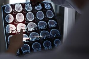 Giornata mondiale dell’Alzheimer, il punto sulle terapie innovative