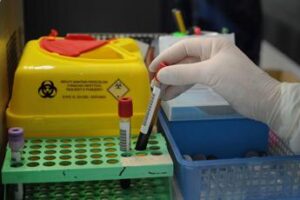 Dermatologo Rossi, ‘alopecia areata nei Lea, spia di altre patologie autoimmuni’