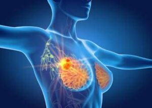 Per cancro seno la cura che arriva dal gelo, Ieo: “Verso un futuro no bisturi”
