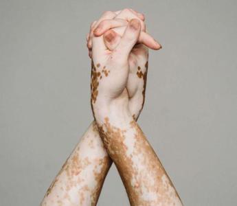 Vitiligine, più casi dopo pandemia Covid: in arrivo primo farmaco in Italia