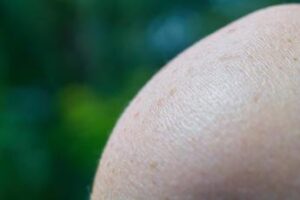 Cos’è il melanoma? Sintomi, prevenzione e successi dell’immunoterapia