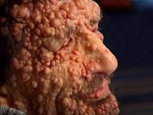 Neurofibromatosi, il morbo che deturpa il volto: ecco la malattia che ha commosso il Papa