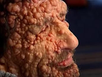 Neurofibromatosi, il morbo che deturpa il volto: ecco la malattia che ha commosso il Papa