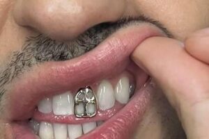 Gioielli sui denti, è grillz mania: possibili rischi