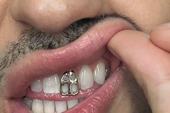 Gioielli sui denti, è grillz mania: possibili rischi