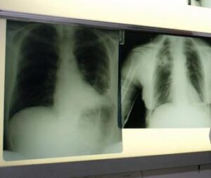 Covid, il timo è lo ‘scudo’ contro danni polmonari a lungo termine