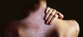 Aggiornamento 2024 del Piano Nazionale Cronicità: dalla Commissione Salute della Conferenza delle Regioni l’invito a prevedere la psoriasi tra le nuove patologie incluse