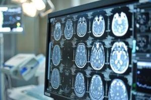 Telemedicina, progetto telestroke permette di trattare ictus a distanza