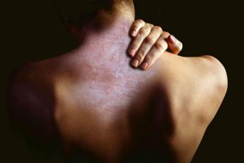 APIAFCO denuncia l’ingiustificata assenza della psoriasi dall’aggiornamento del Piano Nazionale Cronicita. Una discriminazione che nega diritti e dignità a 1,8 milioni di italiani