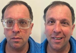 Lenti ICL: una soluzione efficace anche per miopie moderate