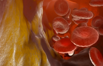 Terapia a Rna riduce colesterolo Ldl di oltre 60%, lo studio italiano