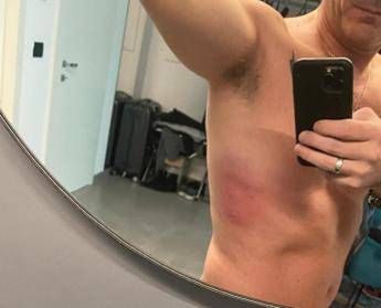 Sanremo 2025, Kekko dei Modà dopo la caduta: “Male alle costole, il dolore persiste”