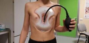 Storia di Marco il nuotatore, guarito dal petto escavato grazie al ‘sottovuoto’