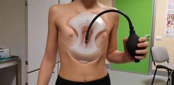 Storia di Marco il nuotatore, guarito dal petto escavato grazie al ‘sottovuoto’