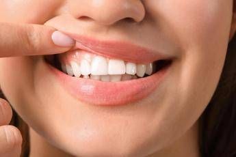 Generazione Z, ‘sorrisi social’ ma gengive malate, 1 su 3 ha problemi orali