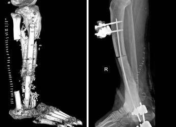 Batterio gli ‘mangia’ la carne, operazione al Gemelli gli salva gamba e piede