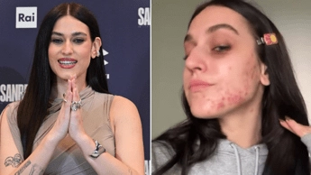 Gaia senza filtri, mostra l’acne sul viso: “Ho pensato di nascondermi, voglio normalizzare”
