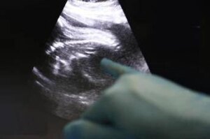 Trapianti, Uk, Amy prima bimba nata da donazione di utero da vivente
