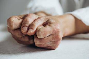 Lo studio, inibitore Il-23 riduce segni e sintomi artrite psoriasica attiva