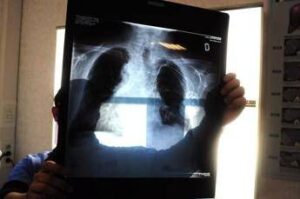 Tumori, in carcinoma polmonare risultati positivi da combinazione in prima linea