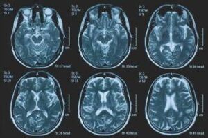 Tumori, glioma pediatrico di basso grado: via libera in Europa a prima terapia mirata