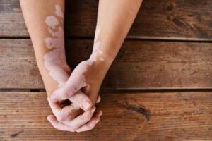 Estate, vitiligine e sole: le regole per una abbronzatura sicura