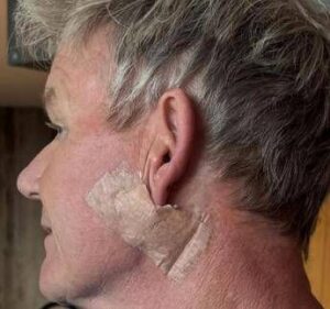 Gordon Ramsay: “Operato per tumore della pelle”