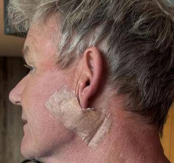 Gordon Ramsay: “Operato per tumore della pelle”