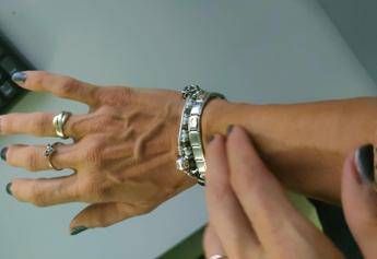 Torna la scabbia, in Italia +750% casi in 3 anni. L’overtourism tra le cause