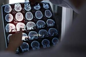 Nuove molecole e bersagli, così si evolve la terapia contro l’Alzheimer: il punto