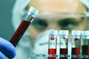Leucemia linfatica cronica, con zanubrutinib sopravvivenza al 74% a 6 anni