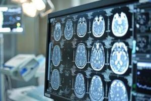 Sanità, presentato Deestrategy, modello per continuità assistenziale in encefalopatie rare