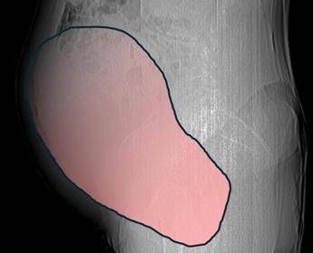 Intervento record al Sant’Anna di Torino, rimosso tumore ovarico di 6 kg