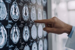 Neurologi: “Per tumori cerebrali la svolta della medicina di precisione”