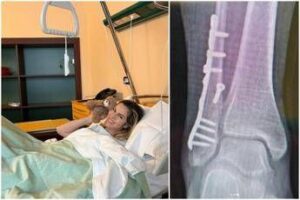 Thais Wiggers, operazione alla caviglia dopo incidente: “Comincio anno con un piede bionico”