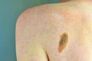 Ogni anno in Italia 2.600 casi ereditari di melanoma, Imi:”Prevenzione con test genetici e controlli”