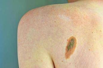 Ogni anno in Italia 2.600 casi ereditari di melanoma, Imi:”Prevenzione con test genetici e controlli”