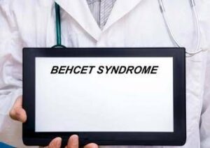 Giornata sindrome Behçet, esperto: “Oggi possiamo prevenire cecità”