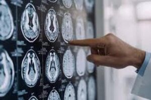 Centro Dbs Pavia, 100 interventi di neurostimolazione profonda per Parkinson
