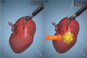 Modelli tridimensionali biomimetici del cancro al rene di un paziente per chirurgia robotica sempre più precisa