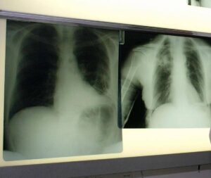 Cancro polmone, con nuova combinazione malattia sotto controllo più a lungo